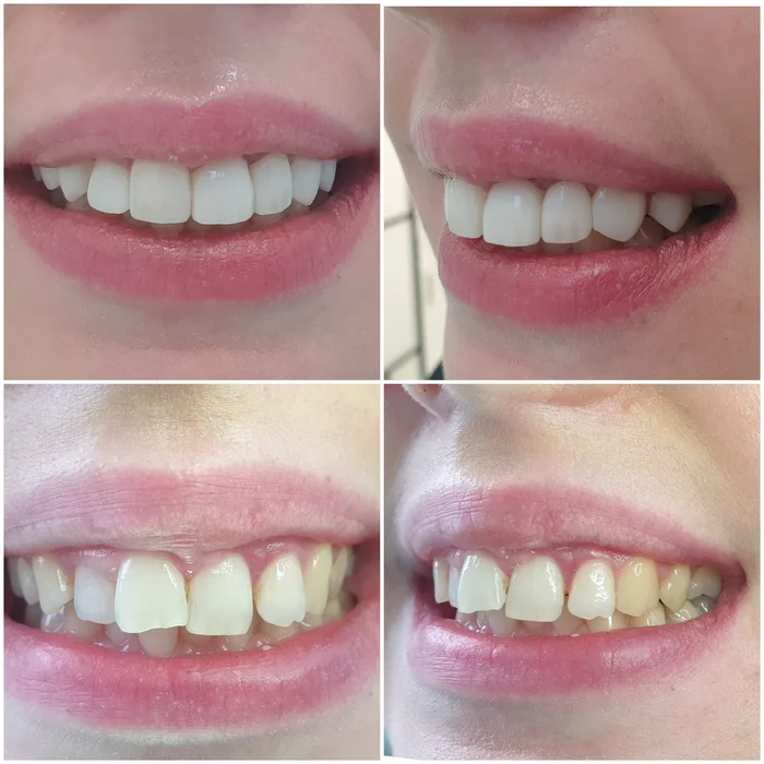 stomatolg chorzow bonding, bonding chorzów, dentysta dziecięcy chorzów, implanty chorzów, licówki kompozytowe chorzów